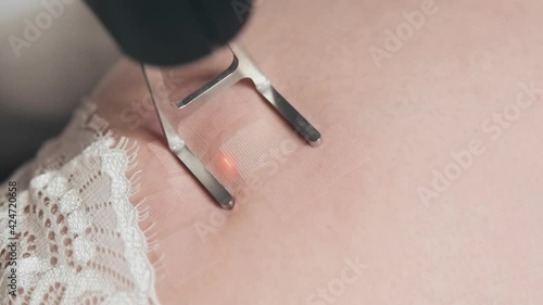 CO2 laser cosmetology, skin resurfacing