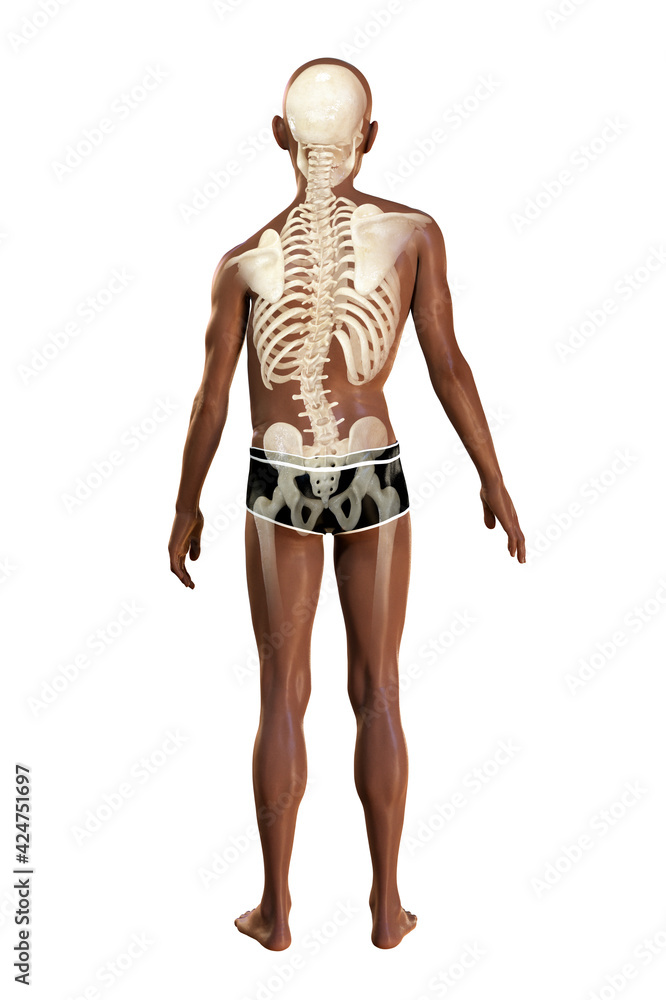 A boy with scoliosis and highlighted skeleton, illustration. Spinal curve anatomy