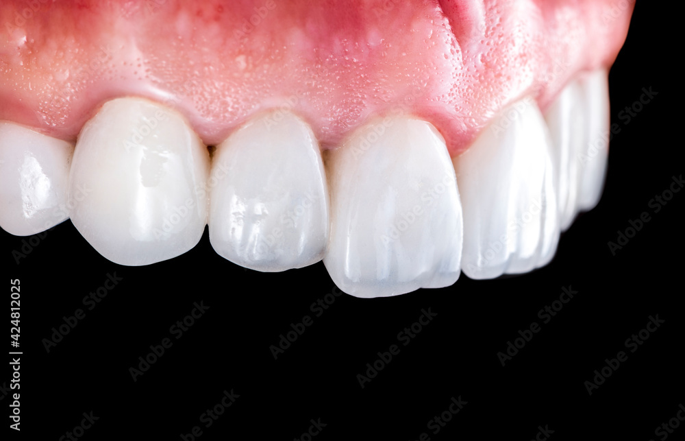 created new smile by crowns implants and veneers