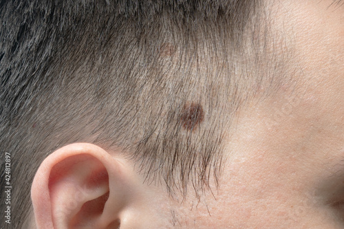 Brown big birthmark on the man's head. photo