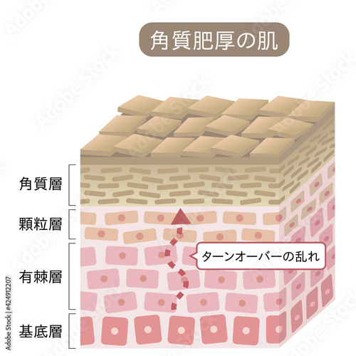 角質肥厚　断面図　立体