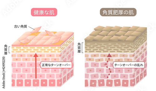 角質肥厚　健康な肌　断面図　立体