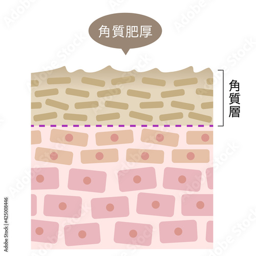角質肥厚　断面図