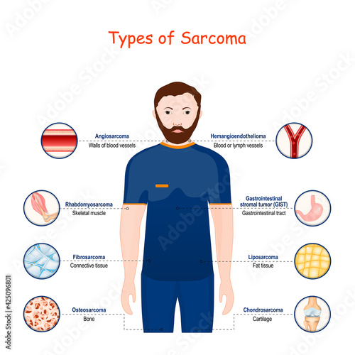 sarcoma. Types of a malignant tumor. cancer