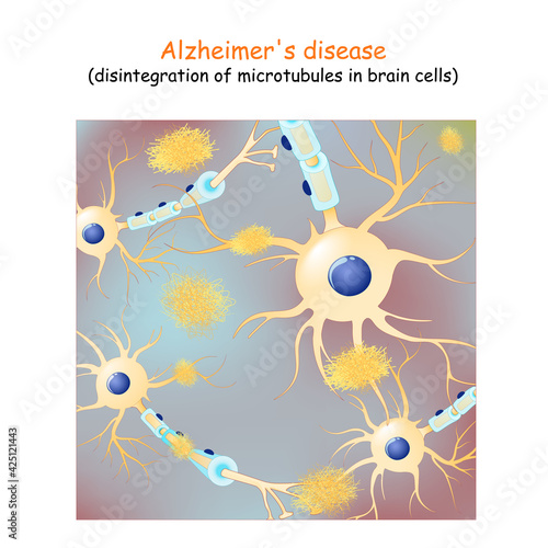Alzheimer's disease. dementia. Vector Background with neurons and amyloid plaques