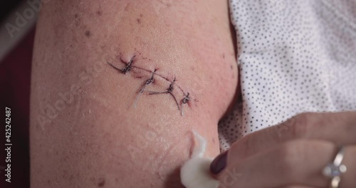 A woman is medicating an arm's sutured wound at home