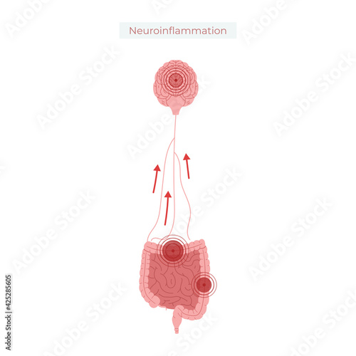Poor gut health leads to neuroinflammation vector illustration.