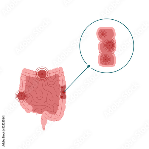 Inflammatory bowel disease vector illustration isolated on white background