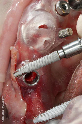 view of a long dental implant before insertion into the bone through a surgical template