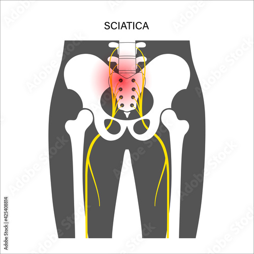 Muscular pelvis concept
