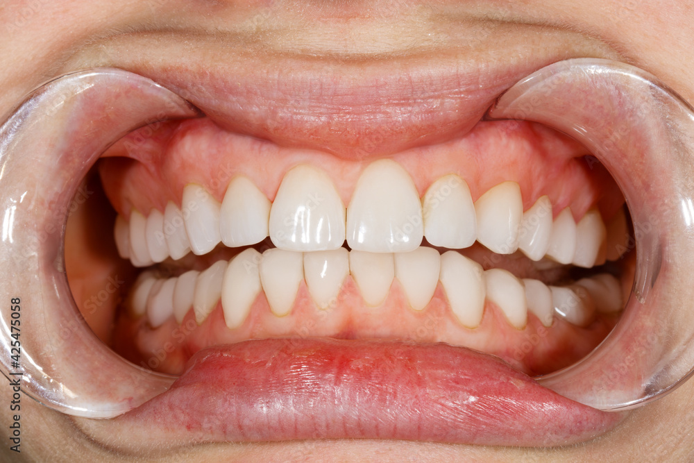 Obraz premium Dental of teeth after treatment. Photo of teeth close up. Teeth whitening image. Treatment plan for new smile. Making bleach veneers. Dental photography