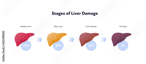 Liver damage infographic. Vector flat illustration. Anatomical human organ. Stages of cirrhosis disease from healthy to fatty and fibrosis. Arrow and percent sign. Design for health care, education