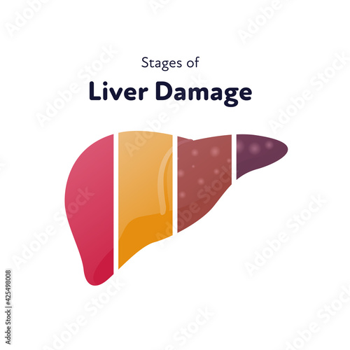 Liver damage infographic. Vector flat illustration. Anatomical human organ. Stages of cirrhosis disease from healthy to fatty and fibrosis on parts of liver. Design for health care, education