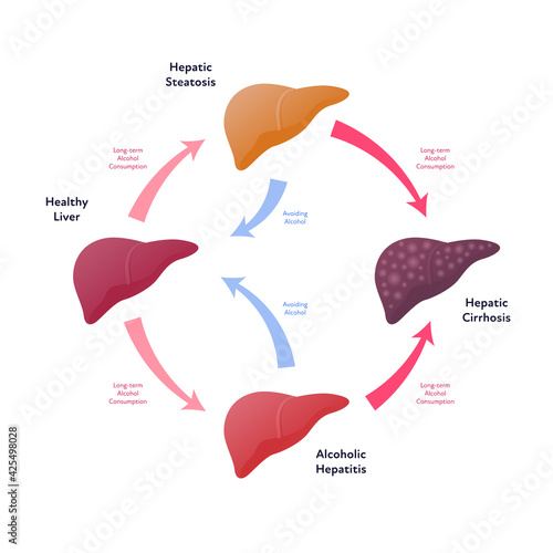 Liver damage infographic. Vector flat illustration. Anatomical human organ. Stages of cirrhosis disease from healthy to fatty and fibrosis. Circle scheme with arrows. Design for health care, education