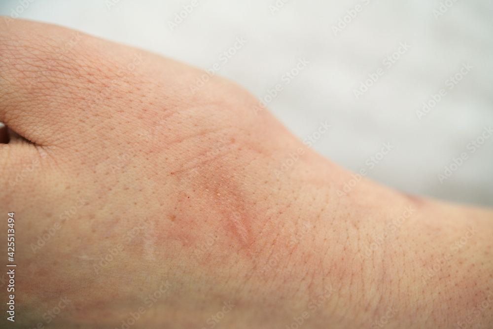 Traces on the arm from after laser therapy
Traces on the arm from after laser therapy