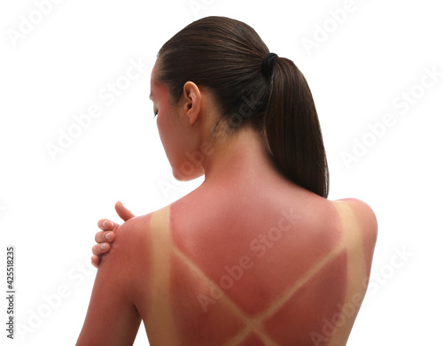 Konstfotografi Woman with sunburned skin on white background, back view