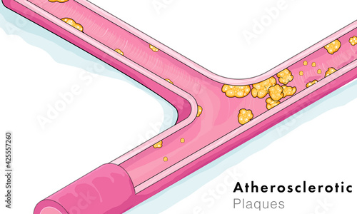 illustration of Atherosclerosis: or fat or cholesterol accumulation in blood vessel. 