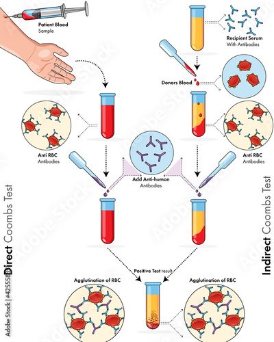illustration of Coombs test of immunology: blood test experiment.