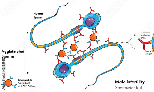 illustration of Male infertility or fertility test: Sperm Mar test.