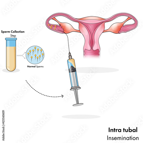 intra tubal form of artificial insemination for pregnancy vector illustration 