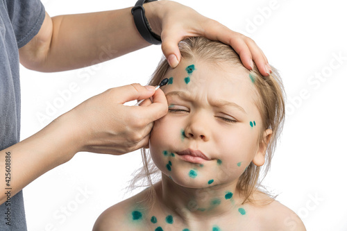 Εκτύπωση καμβά A seven year old girl suffers from an infectious disease of chickenpox, her pimples are smeared with brilliant green