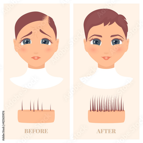 Woman with thinning hair before and after hair loss restoration. Female pattern baldness set with skin cross-section diagram. Treatment result in front view. Alopecia infographics medical vector.
