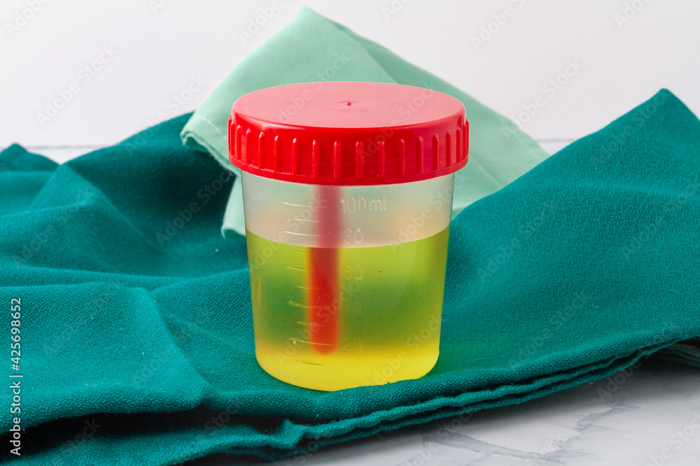 Container with urine for analysis on a table with green hospital cloths