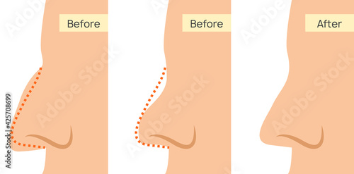Rhinoplasty nose plastic surgery icon. Vector rhinoplasty beauty face icon surgery
