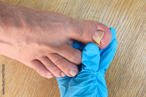 Ingrown toenail on foot. Doctor examines thumb. photo