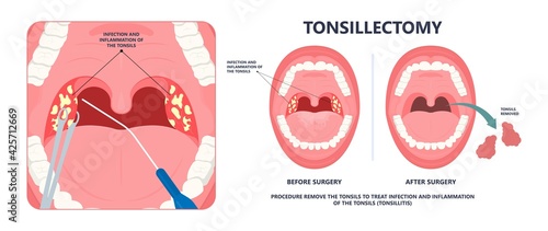 Tonsil Stones crypts viral virus gland strep throat sore enlarged lymph nodes neck pain swollen pus white mouth bacteria Herpes simplex HSV cold fever Epstein Barr fetid bad odor oral laser aureus