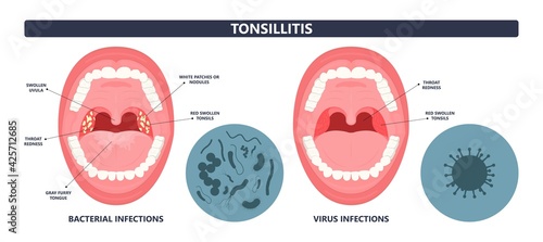 Tonsil Stones crypts viral virus gland strep throat sore enlarged lymph nodes neck pain swollen pus white mouth bacteria Herpes simplex HSV cold fever Epstein Barr fetid bad odor oral laser aureus photo