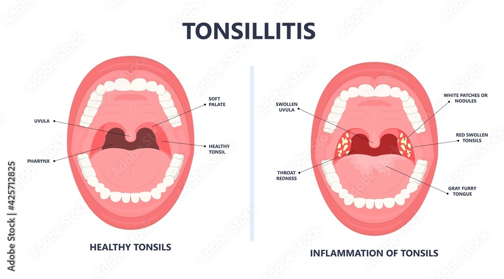 Tonsil Stones crypts viral virus gland strep throat sore enlarged lymph