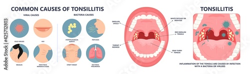 Tonsil Stones crypts viral virus gland strep throat sore enlarged lymph nodes neck pain swollen pus white mouth bacteria Herpes simplex HSV cold fever Epstein Barr fetid bad odor oral laser aureus
