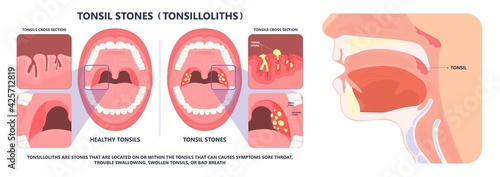 Tonsil Stones crypts viral virus gland strep throat sore enlarged lymph nodes neck pain swollen pus white mouth bacteria Herpes simplex HSV cold fever Epstein Barr fetid bad odor oral laser aureus