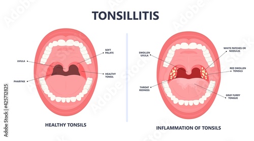 Tonsil Stones crypts viral virus gland strep throat sore enlarged lymph nodes neck pain swollen pus white mouth bacteria Herpes simplex HSV cold fever Epstein Barr fetid bad odor oral laser aureus photo