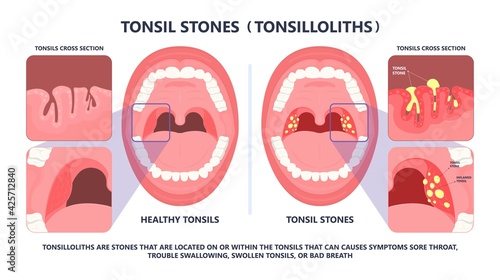 Tonsil Stones crypts viral virus gland strep throat sore enlarged lymph nodes neck pain swollen pus white mouth bacteria Herpes simplex HSV cold fever Epstein Barr fetid bad odor oral laser aureus