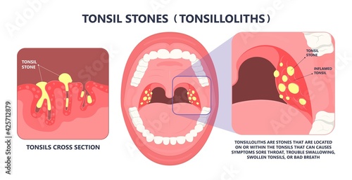 Tonsil Stones crypts viral virus gland strep throat sore enlarged lymph nodes neck pain swollen pus white mouth bacteria Herpes simplex HSV cold fever Epstein Barr fetid bad odor oral laser aureus