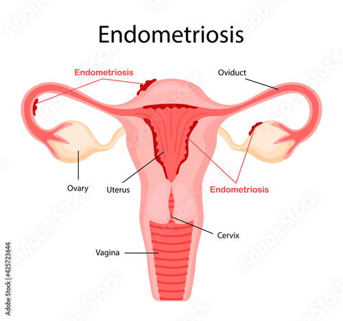 Diagram of endometriosis. Diseases of the female reproductive system. Vector illustration in a flat cartoon style.