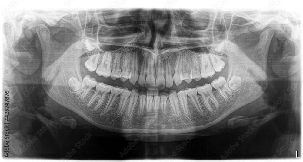 Foto Stock Orthopantomography of human jawes, OPG Xray DR digital with Impacted wisdom teeth