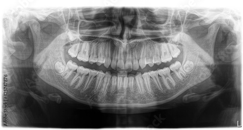 Orthopantomography of human jawes, OPG X-ray DR digital with Impacted wisdom teeth visible