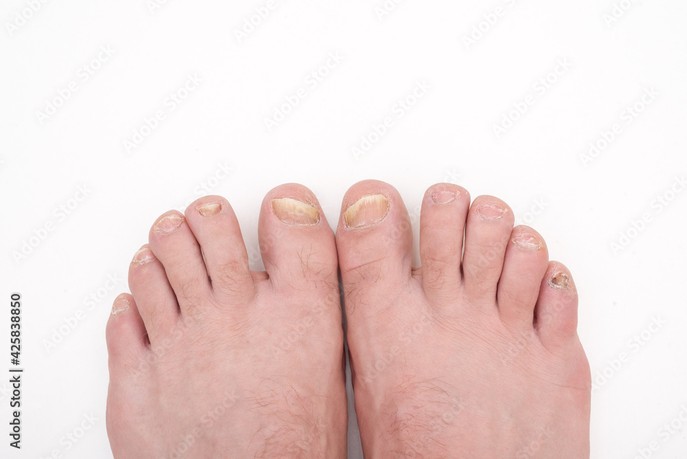 onychomycosis is a fungal infection of the nail. Legs with injured affected nails on a white background in a close-up. Diagnostics and treatment of mycoses of the feet. Scary toenails. onychomycosis is a fungal infection of the nail. Legs with injured affected nails on a white background in a close-up. Diagnostics and treatment of mycoses of the feet. Scary toenails.