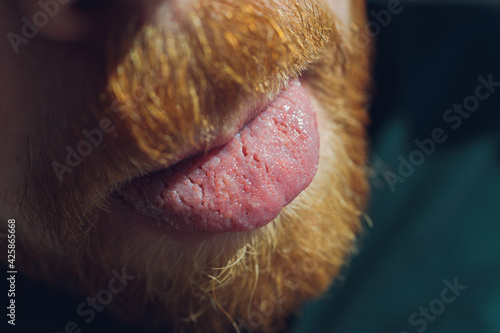 Bacterial infection disease tongue in a man.