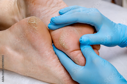 A pedicure doctor examines a patient's feet with problematic heels with cracks and dry skin. Foot treatment and care for diabetic skin.