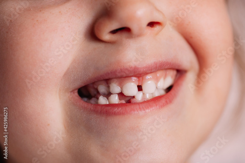 close-up the smiling mouth of a five-or six-year-old child with a hole in the gum on the lower row of teeth from a fallen baby tooth, pride in growing up.