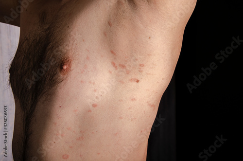 Pityriasis rosea is a type of skin rash