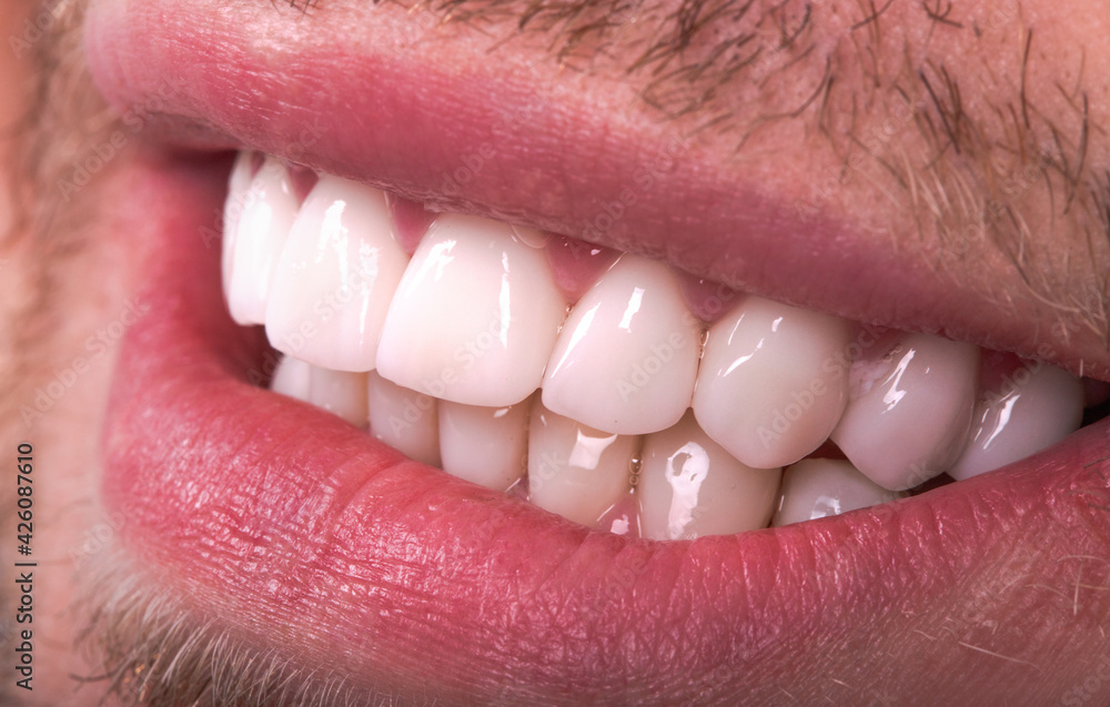 Obraz premium Perfect Close Up White beautiful Veneers Teeth bleaching crowns whitening young lady smiling, Male beard natural man smile. Dental zircon implants restoration surgery. Fashion concept