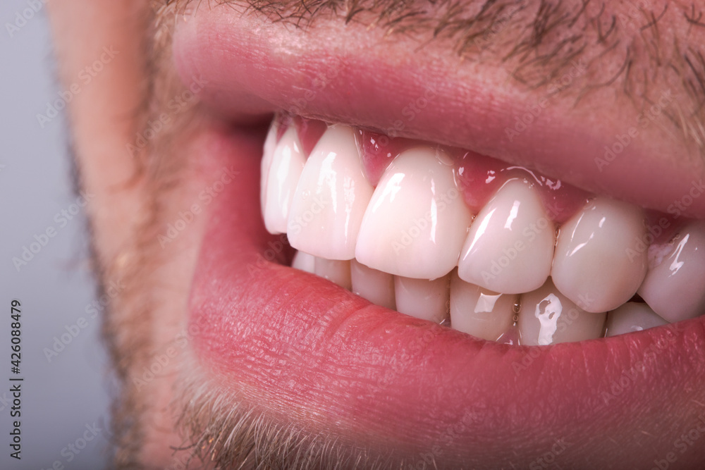 Obraz premium Perfect Close Up White beautiful Veneers Teeth bleaching crowns whitening young lady smiling, Male beard natural man smile. Dental zircon implants restoration surgery. Fashion concept