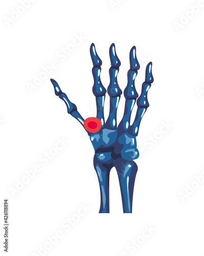 Rheumatology hand bones