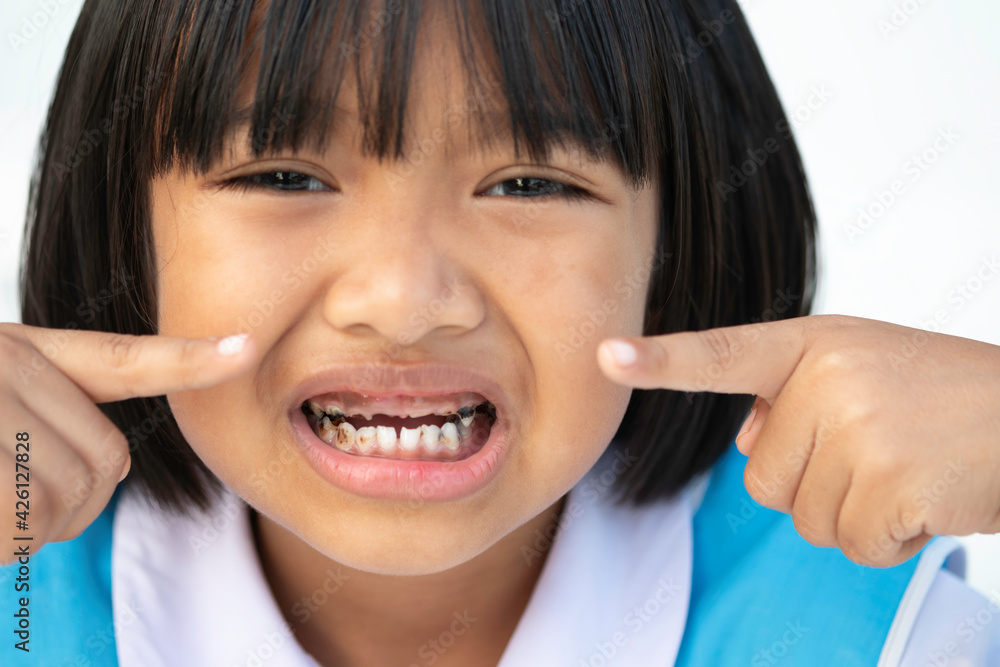 child open mouth to showing caries teeth decay, signs of tooth decay