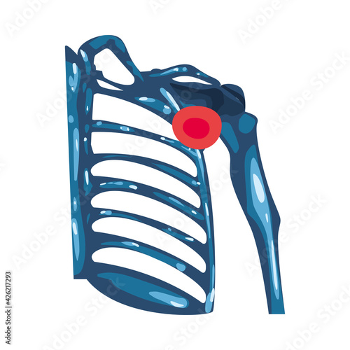 Rheumatology ribs bones